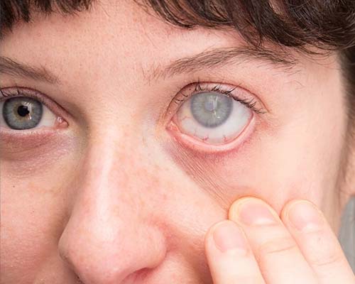 Tratamiento de Cataratas